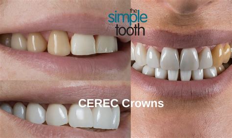 fabrication of metal ceramic crown|cerec crowns pros and cons.